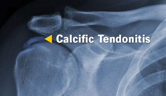 Calcific tendinopathy (CT) of the shoulder