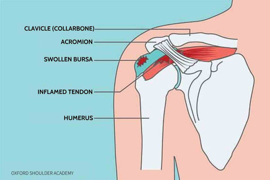 Subacromial Impingement and Frozen Shoulder