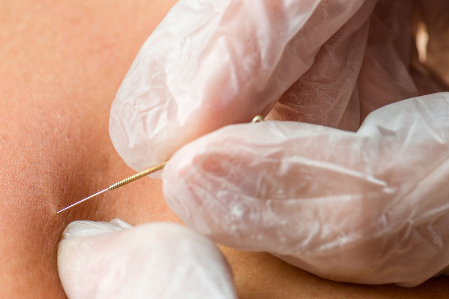 Dry Needling for Trigger Points (18 hrs)